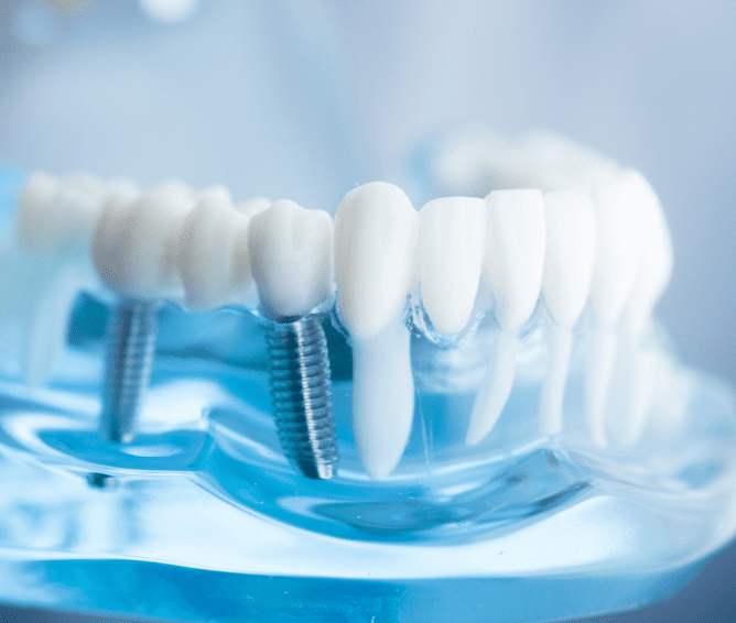 インプラント画像 sp